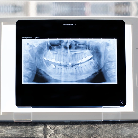 Digital dental X ray displayed on a tablet screen showing a full set of teeth